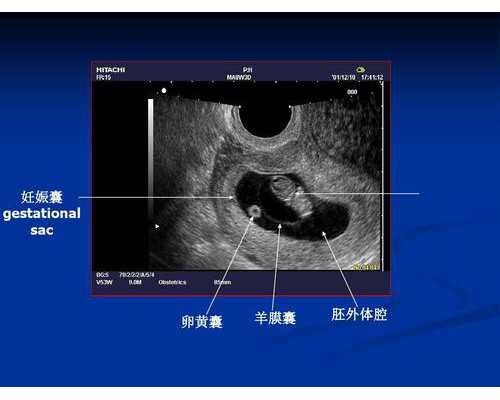 孕宝代孕网,穿刺取精精子质量不高？穿刺取精为什么？