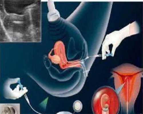 包生男孩价格低_代孕宝宝包性别,优势卵泡|三个优势卵泡都排了怀孕几率多大？