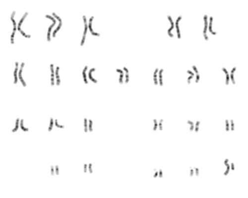 无中生有-无精症患者显微取精手术成功获取足量精子