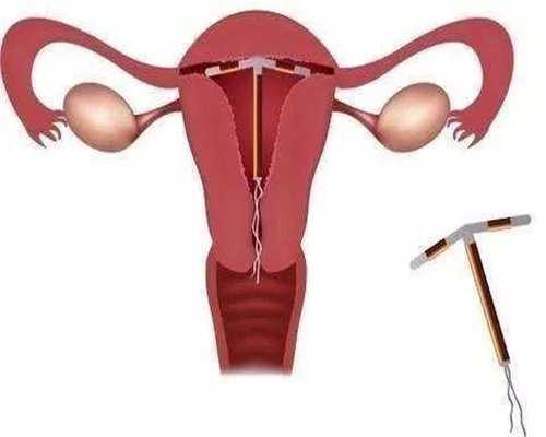 怎么找代孕，毕节借卵试管婴儿，多囊卵巢综合